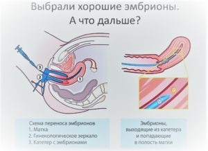Спазм ШМ при переносе эмбриона