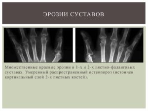 Профилактика эрозии суставов при ревматоидном артрите