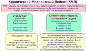 Лечение хронической лейкемии