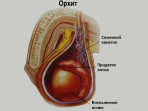 Мокреет головка и дискомфорт в правом яичке