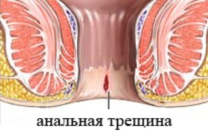 Растяжение анального кольца