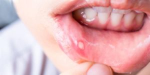 Здоровье полости рта: Стоматит