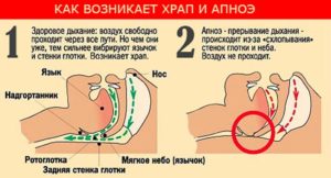 Храп: причины и последствия