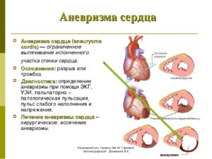 Постинфарктная аневризма сердца