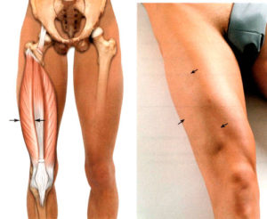 уплотнение на икроножной мышце или кости