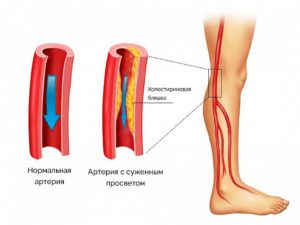 Облитерирующий атеросклероз