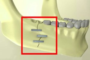 Реабилитация после перелома нижней челюсти
