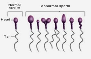 А коли 90% дегенеративних форм сперматозоїдів, то це лікується?