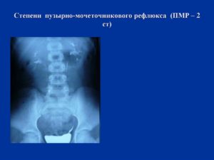 Пузырно мочеточниковый рефлюкс 2 степени у 8 мес ребенка