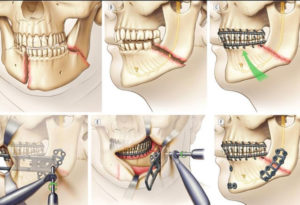 Неправильно срослась нижняя челюсть после перелома