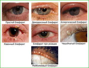 Лечение блефарита, или воспаление края век