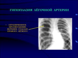 Стеноз легочной артерии.Гипоплазия носовой кости.