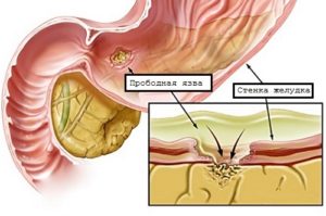 Пенетрация язвы желудка и двенадцатиперстной кишки