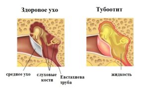 Острый и хронический тубоотит (евстахиит)