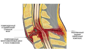 Повреждения позвоночника