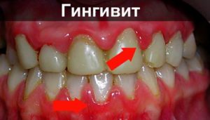Симптомы болезни - боли в зубах при беременности