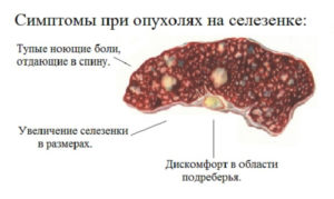 Симптомы болезни - боли в селезенке