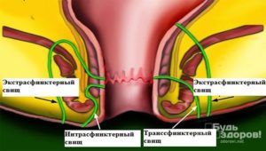 чрессфинктерный свищ