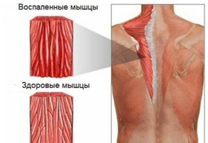 Уплотнение в мышечной ткани