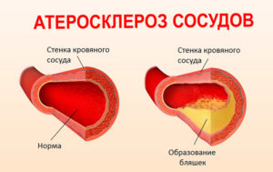 Гипертония: Высокое артериальное давление и атеросклероз