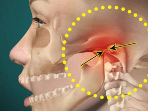 Дисфункция височно-нижнечелюстного сустава