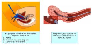 Тонус матки после переноса эмбрионов