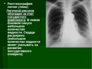 ФЛГ: Обогащён прикорневой лёгочный рисунок