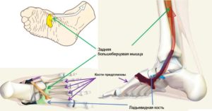 Тендинит задней большеберцовой мышцы