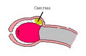 Повышенное выделение смегмы