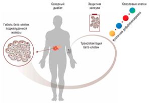 Трансплантация островковых клеток в качестве одного из способов лечения сахарного диабета