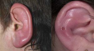 Воспалительные заболевания наружного уха (продолжение...)
