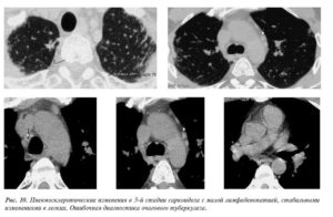саркоидоз, результаты КТ
