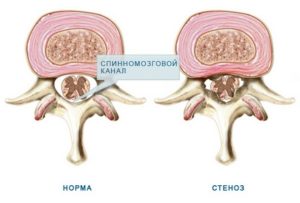 Стеноз спинномозгового канала