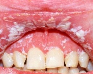 Молочница (кандидоз) полости рта