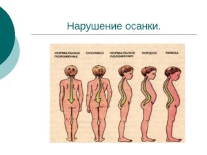 Как называется нарушение осанки изображенное на рисунке 3