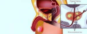Можно ли делать массаж предстательной железы при кальцинатах