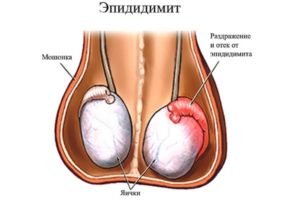 Застудил пах(яички)