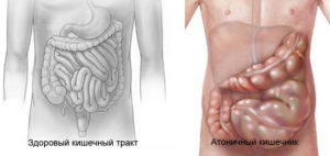 Гипотонус толстой кишки