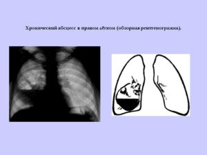 Хронический абсцесс легкого