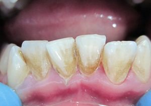 Потемнение зубной эмали