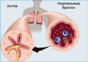 Заболевания, которые похожи на астму (подражатели астмы)