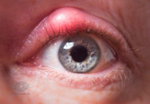 Симптомы болезни - глазные боли