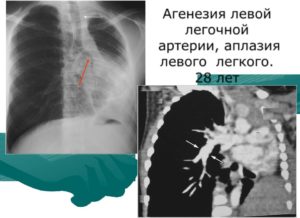 Стеноз легочной артерии.Гипоплазия носовой кости.