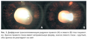 Трансиллюминация и диафаноскопия глазного яблока