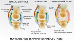 Виды артрита