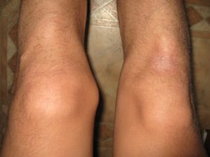 Уплотнение над коленом слева