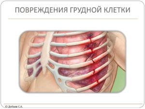 Повреждения грудной клетки