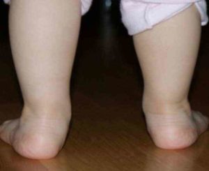 Ребенок неправильно ставит ногу.