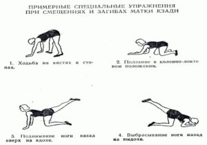 ЛФК при неправильных положениях матки