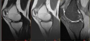 Расшифруйте МРТ , травма колена